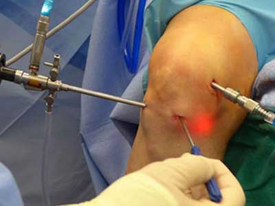 Arthroscopy